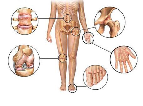 Артрит поражает многие суставы