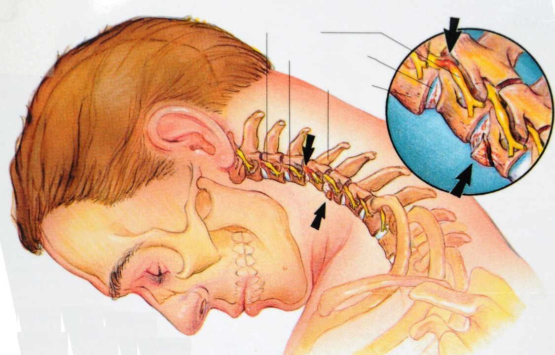 остеохондроз шейного отдела позвоночника